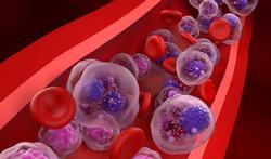 Multipel myeloom (ziekte van Kahler): symptomen, oorzaken, behandeling en prognose