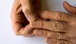 Ongles striés : causes des lignes sur les ongles