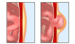 Navelbreuk: wanneer is een operatie nodig?