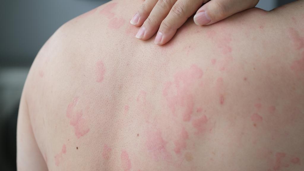 © Getty Images - photo d'une éruption d'urticaire sur le dos Getty_netelroos_urticaria_rug_allergie_2025.jpg