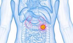 Wat zijn de symptomen van nierkanker?