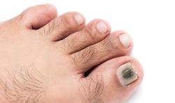 Syndrome des ongles verts : une infection à Pseudomonas