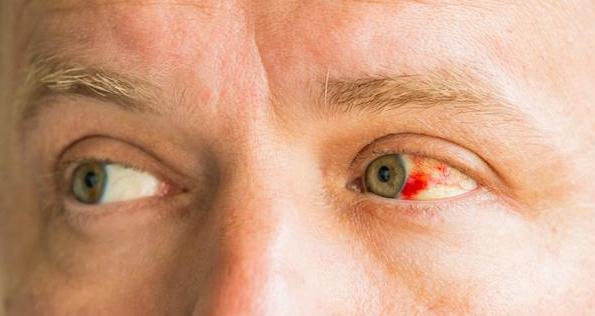 Getty_oog_bloed_veine_eclatee-oeil_2025.jpg