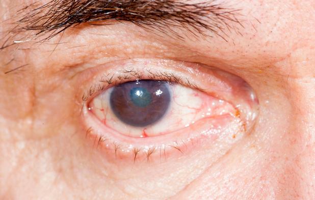 Getty_oog_oeil_cataract_2025.jpg