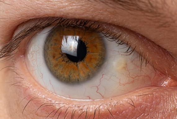 Getty_oog_pinguecula_oeil_2025.jpg