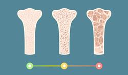 Osteopenie: verminderde botmassa