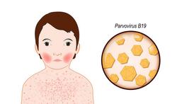Parvovirus B19 (vijfde kinderziekte) vooral voor zwangere vrouwen gevaarlijk