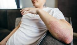 Psoriatische artritis: psoriasis en gewrichtspijn