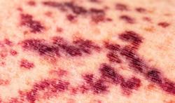Purpura rhumatoïde : causes, symptômes, traitements 