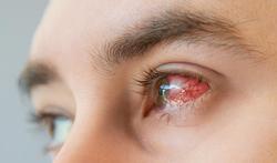 Keratitis: rood oog door ontsteking van het hoornvlies