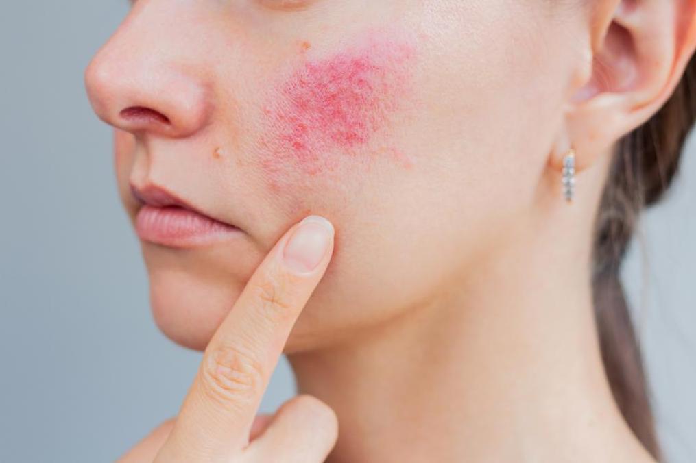 © Getty Images Getty_rosacea_2025.jpg