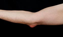 Slijmbeursontsteking (bursitis): symptomen en behandeling