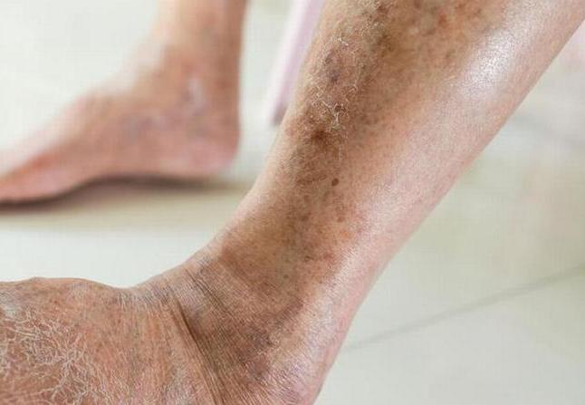 © Getty Images Getty_suikerplekken_diabetes_peau_2023.jpg
