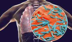 Tuberculose (tbc): symptomen, besmetting en behandeling