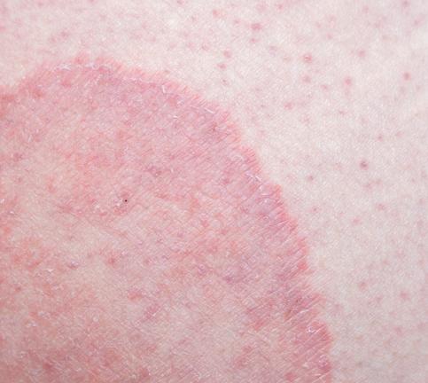 Getty_tinea_cruris_ringworm_2025.jpg