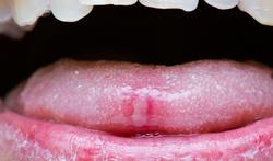 Aphtes : quelles sont les causes possibles ?
