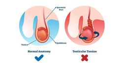 Torsion testiculaire : une douleur intense dans un testicule et une urgence médicale