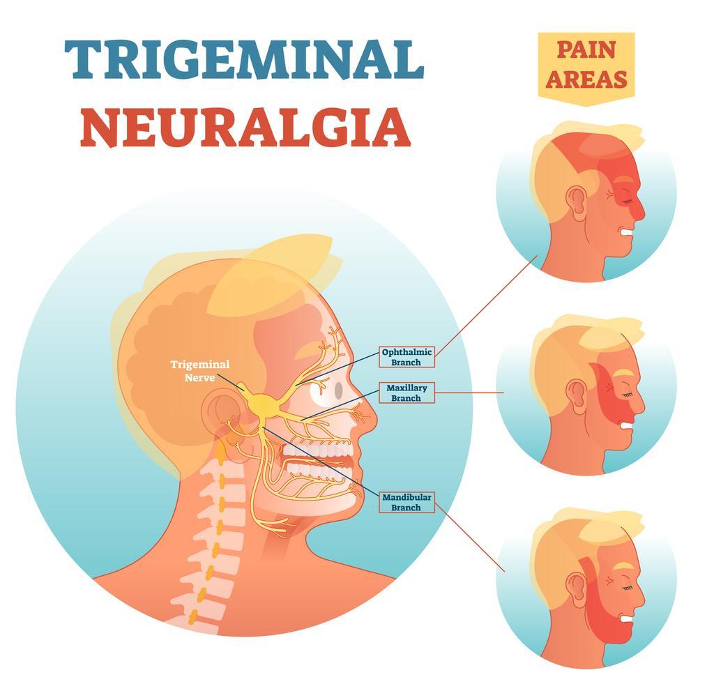 Getty_trigeminusneuropathie_2024.jpg