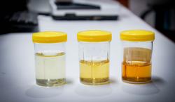 Urine transparente : faut-il s’inquiéter ?