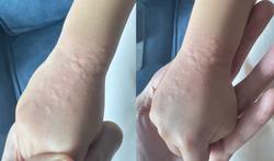 Urticaire au froid : une réaction allergique au froid ?