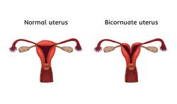 Uterus bicornis: een ‘dubbele baarmoeder’