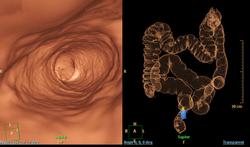 Coloscopie virtuelle en Belgique : pour qui et pour quoi  ?
