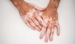 Vitiligo: witte pigmentvlekken op de huid