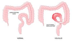 Volvulus of darmtorsie: wat zijn de symptomen?
