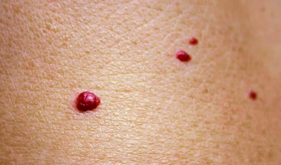 C'est quoi ces petits points rouges sur la peau : angiome rubis ou ...