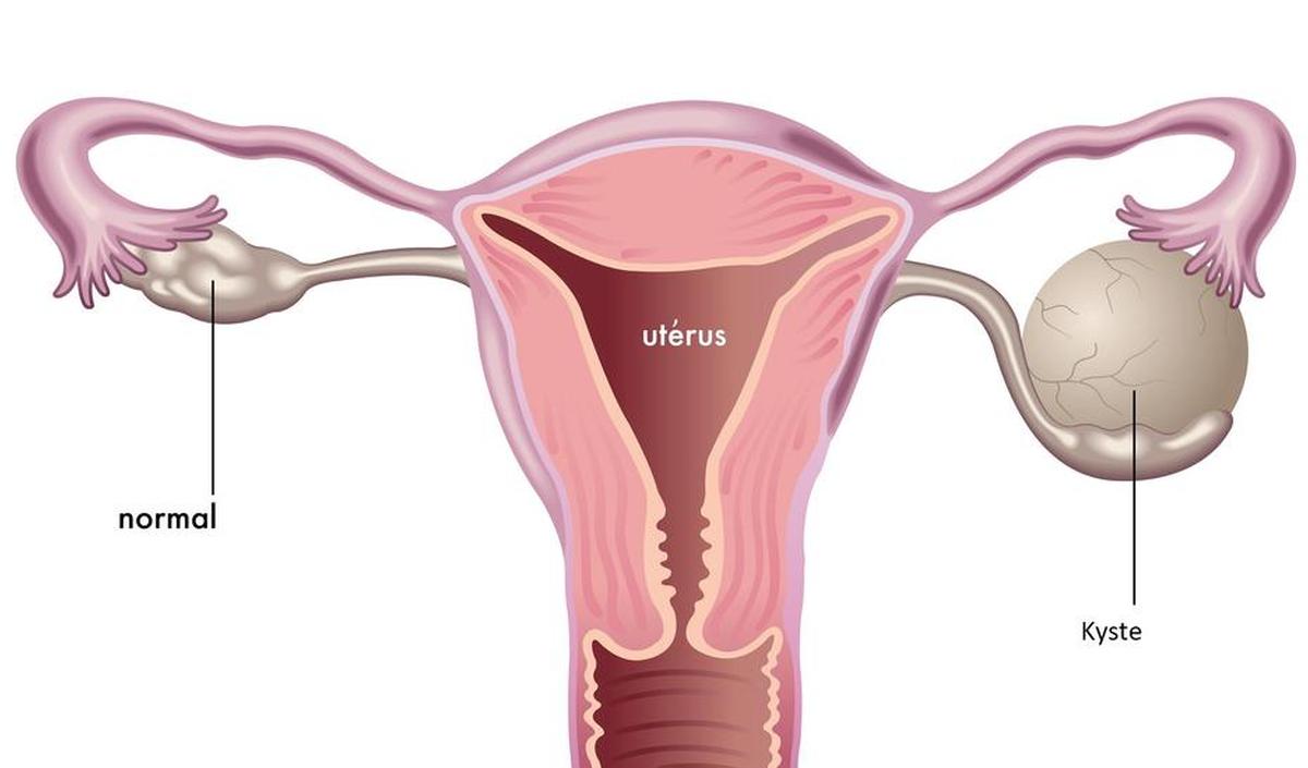 Kyste ovarien : causes, symptômes, traitement | PassionSanté.be