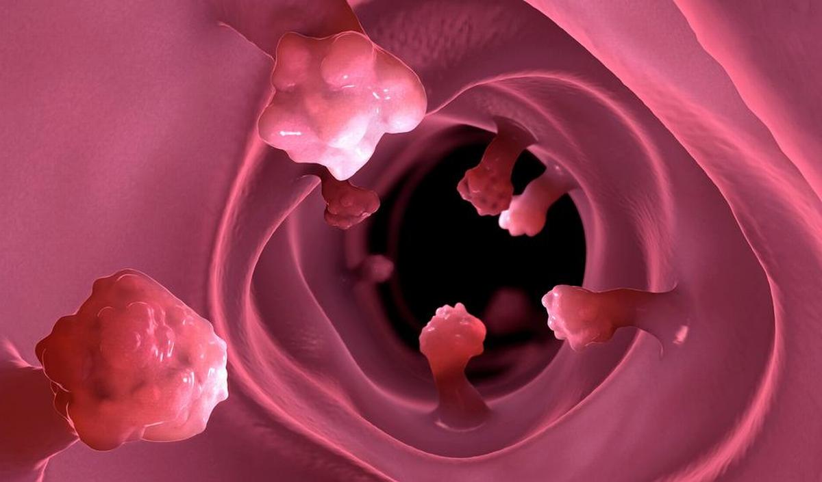 Research: colon cancer soon to be detected thanks to a simple blood test?