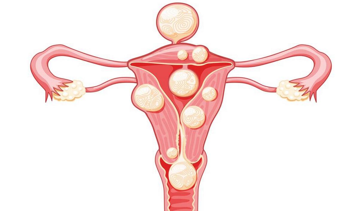 Myomen, vleesbomen, fibromen goedaardige gezwellen in de baarmoederwand gezondheid.be foto