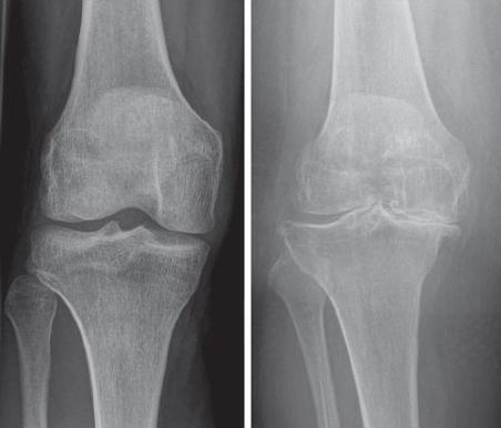 arthrose1.jpg