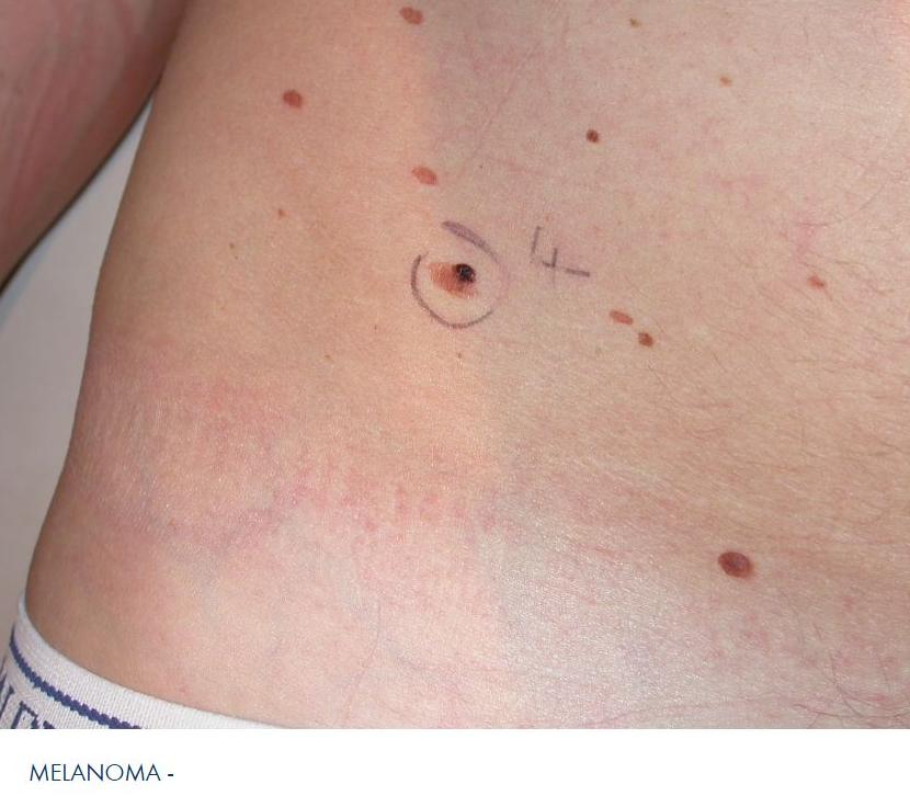 http://www.euromelanoma.org euromel-melanoma-ca-04-17.jpg