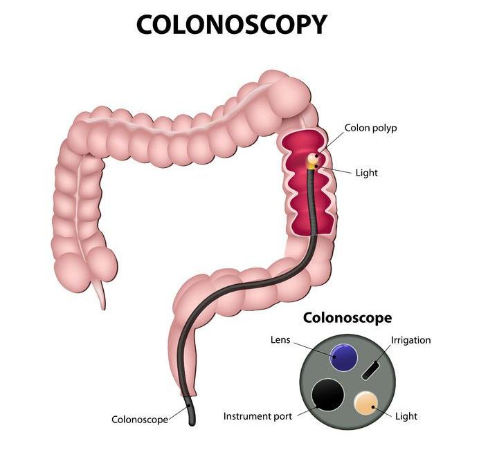 f-123-anatom-colonoscopy-04-18.jpg
