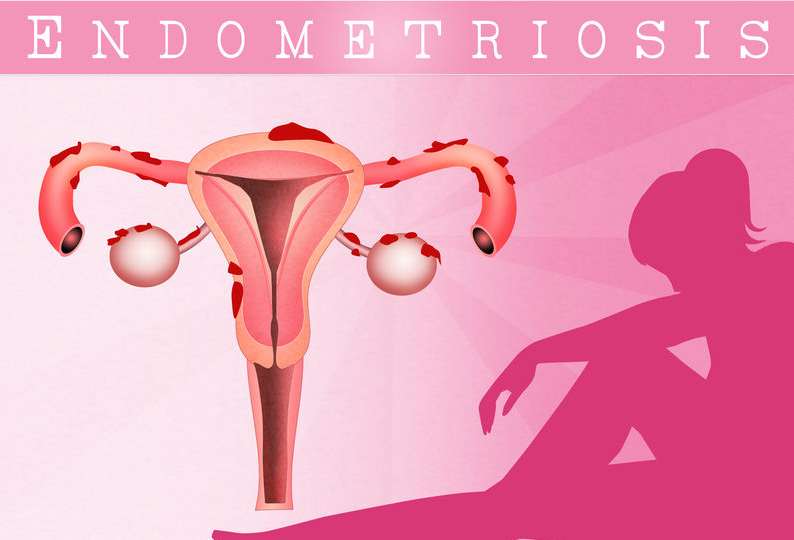 f-123-endometriosis-01-19.png