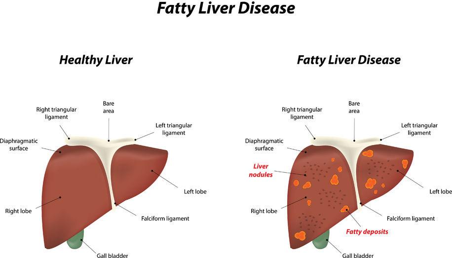 f-123-txt-tek-fatty-liver-nalf-leverziekten-oorz-sympt-01-18.jpg