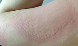 free-_Urticaria_3.jpg