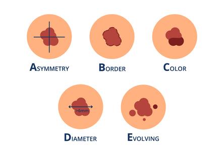Tache sur la peau : reconnaître les symptômes d'un cancer de la ...