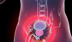 Prostaatkanker: symptomen en behandeling