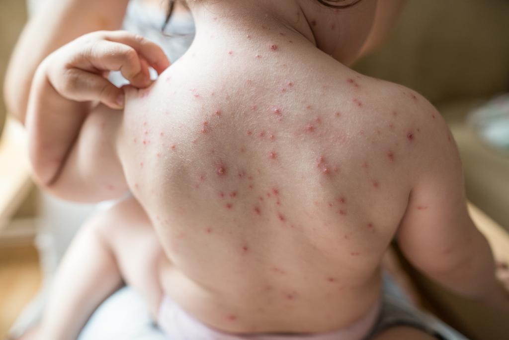 Taches ou boutons rouges sur la peau : de quelle maladie infantile ...