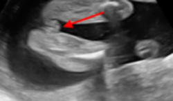 Het geslacht van een baby zien op een echo ‘via de onderkant’