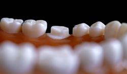 Se faire limer toutes les dents pour poser des couronnes : la tendance qui inquiète les dentistes
