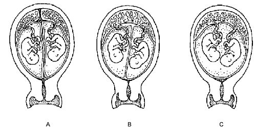 soorten-tweeling-placenta.jpg