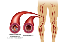 Perifeer arterieel vaatlijden (PAV) of 'etalagebenen'