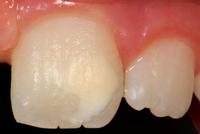 tand-witte-vlek-kaasmolaar-200.JPG