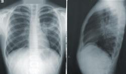 Vidéo - Tuberculose : causes, symptômes, traitement