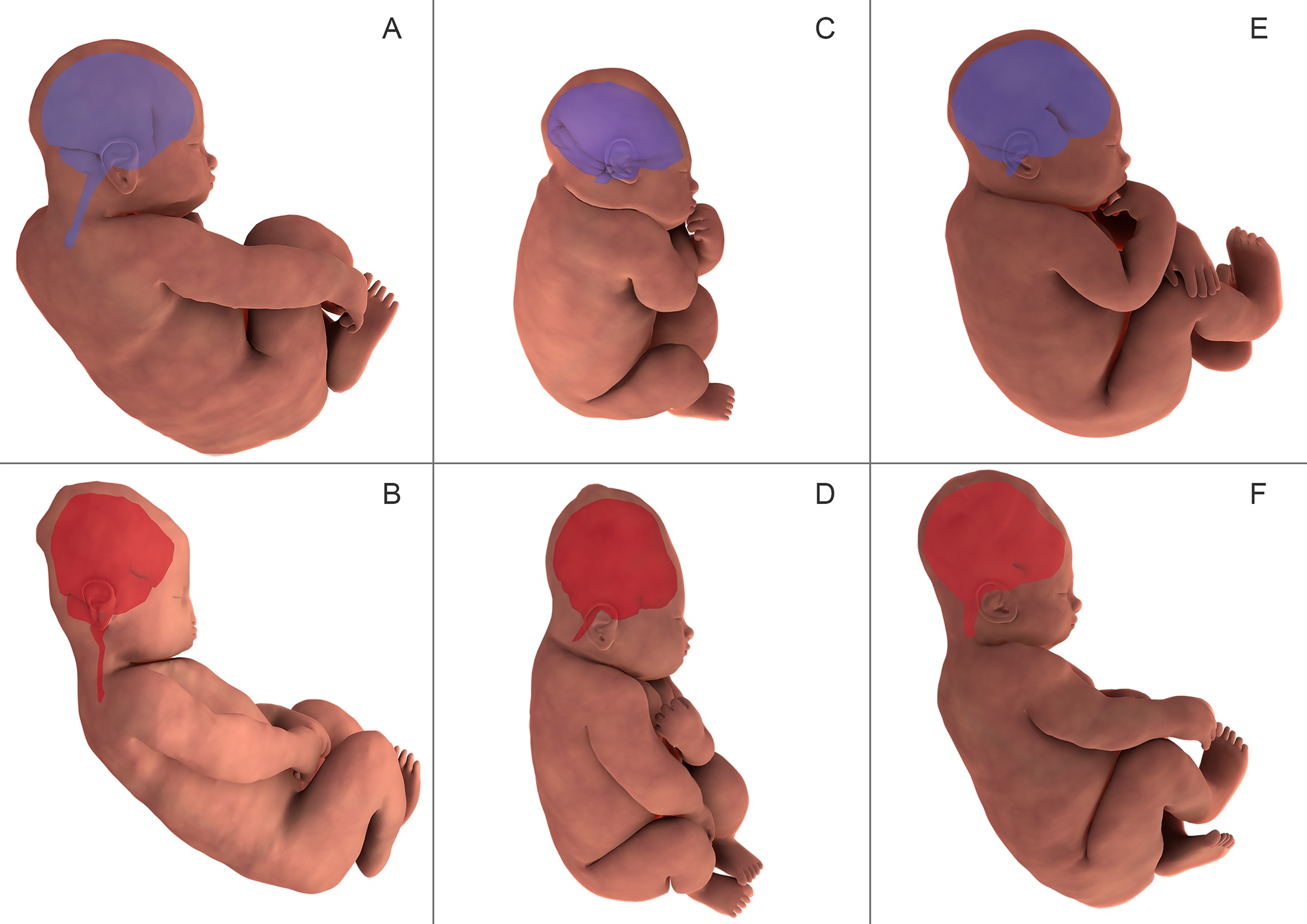 Sluimeren paling Mark Zo vervormt de schedel van een baby tijdens de geboorte | gezondheid.be