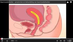 Video : Baarmoederkanker