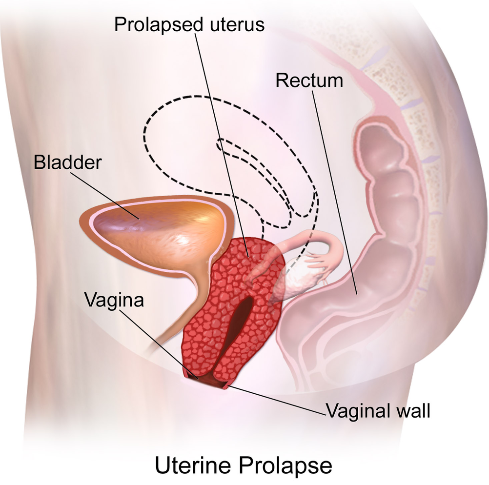 web-Uterus-Prolaps-1-01-19.png